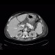 Chronic pancreatitis, dilated pancreatic duct: CT - Computed tomography